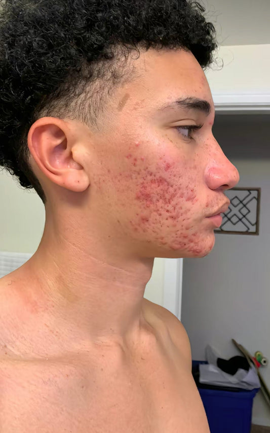 Veroorzaken eiwitshakes Acne? Dit moet je weten!