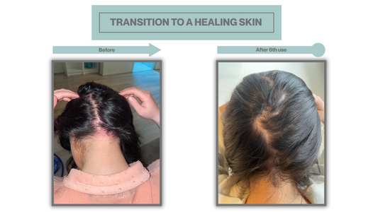 Gezonde hoofdhuid: 5 essentiële tips